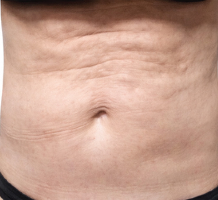 body-treat-10-bfr
