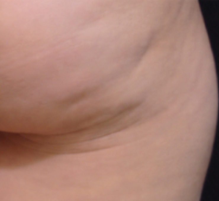 body-treat-12-bfr