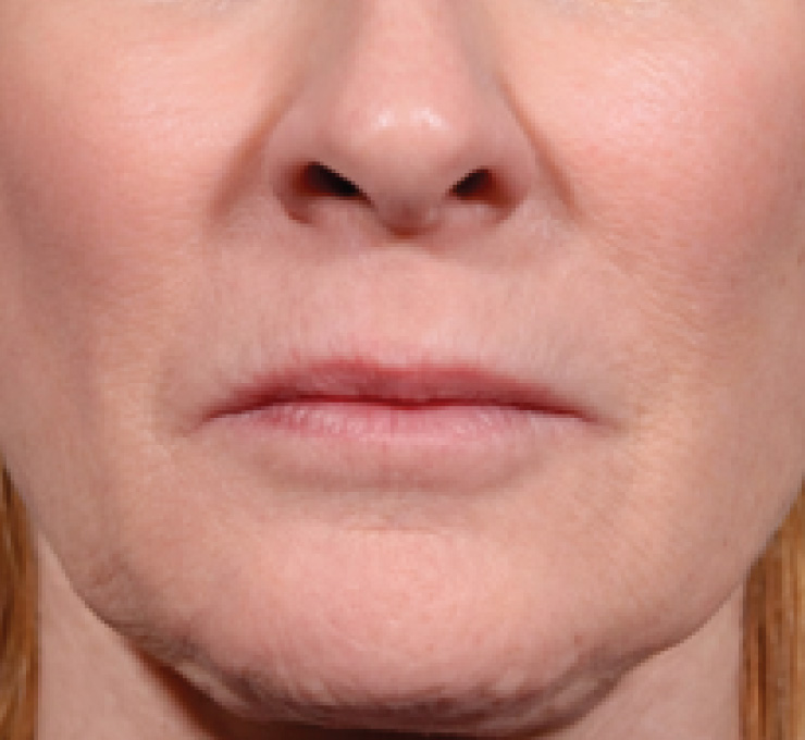 body-treat-13-bfr