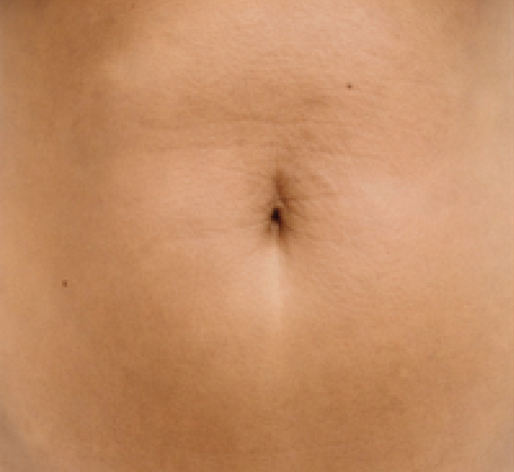 body-treat-3-aft