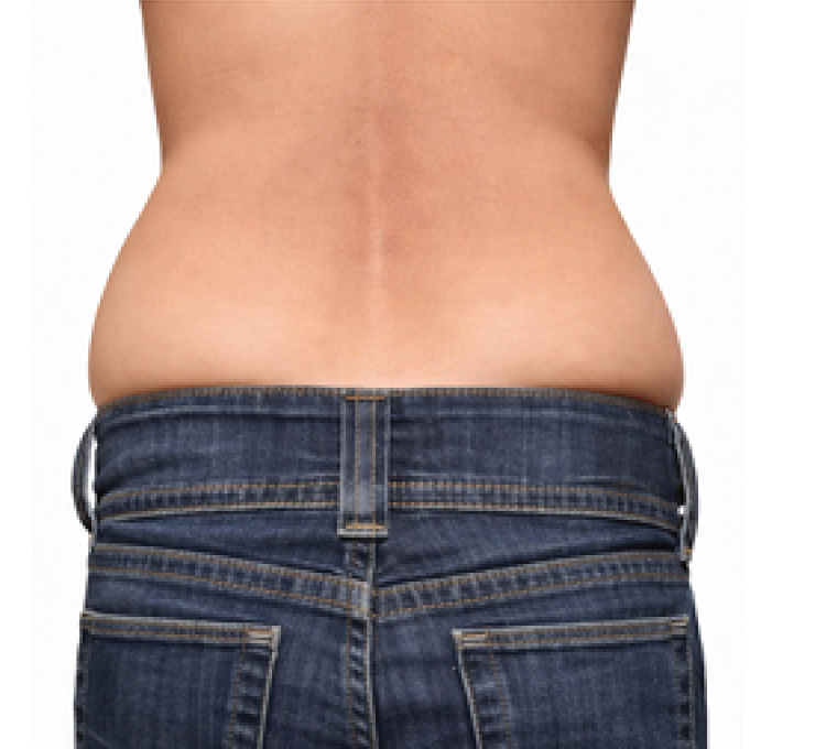 body-treat-5-bfr