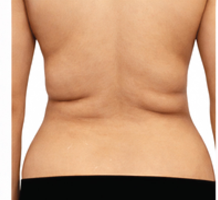 body-treat-6-bfr