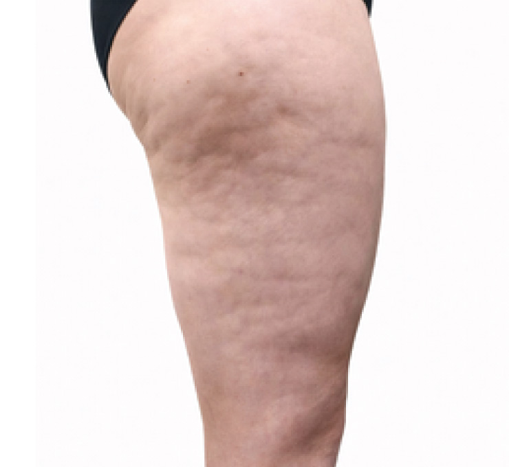 body-treat-9-bfr