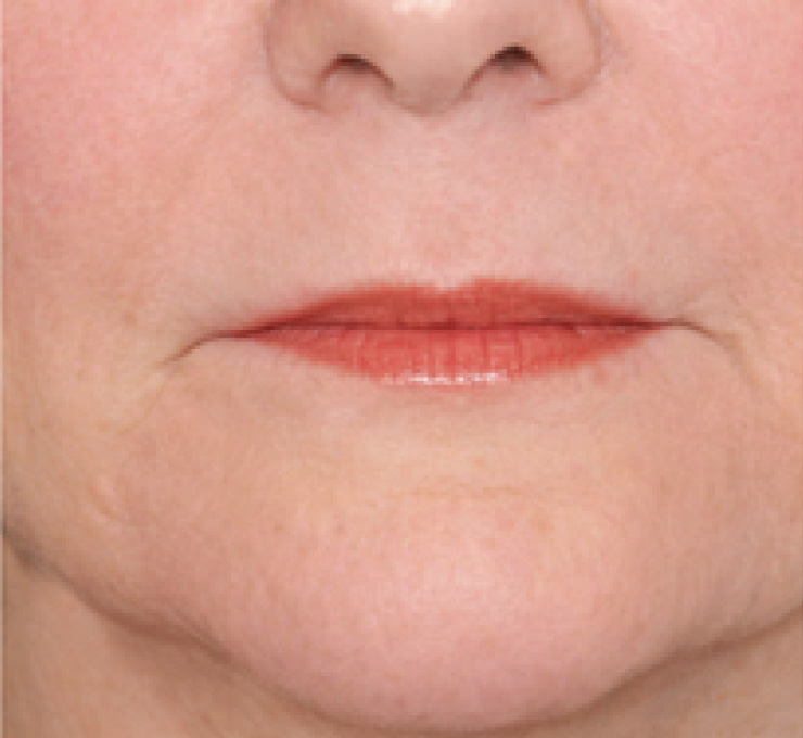 derma-10-aft