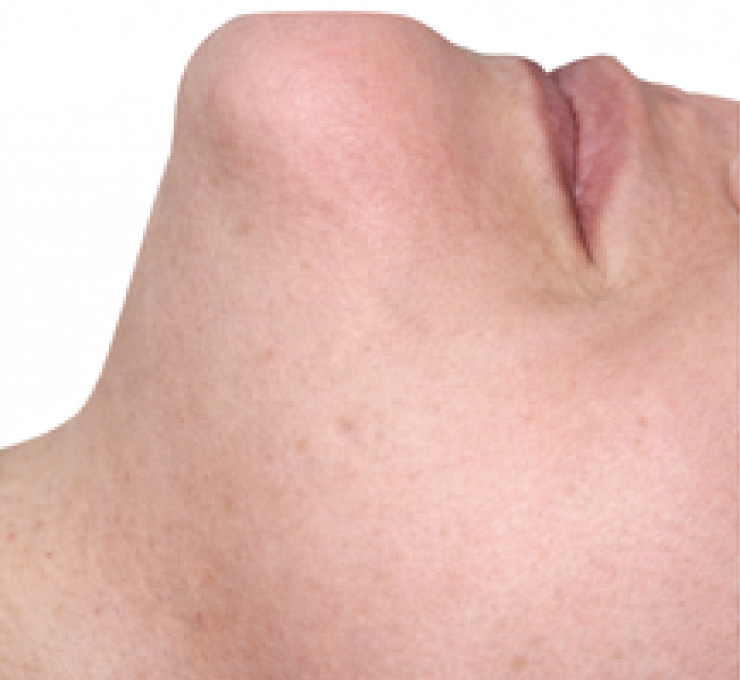 derma-11-aft
