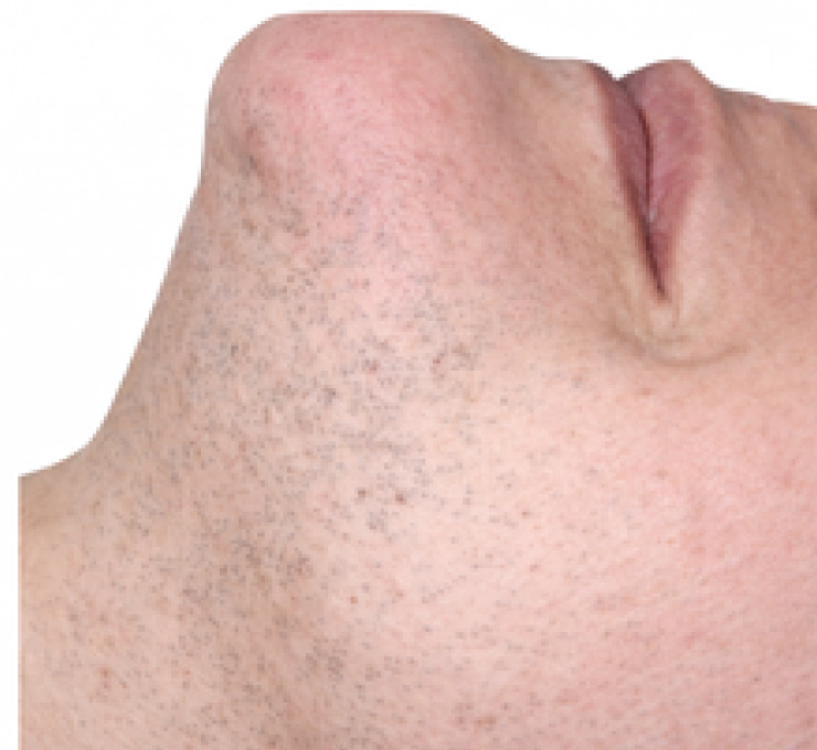 derma-11-bfr