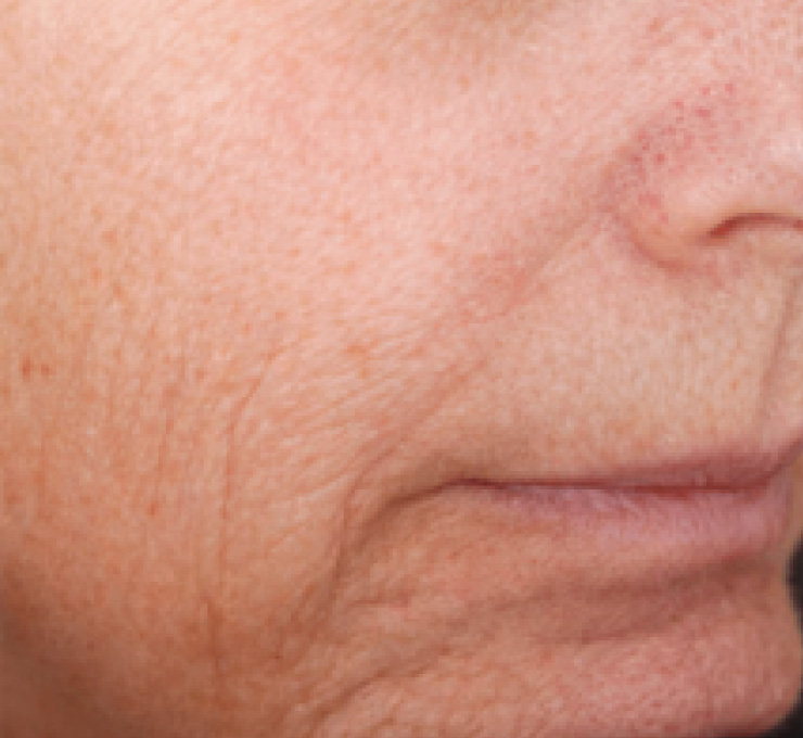derma-12-bfr
