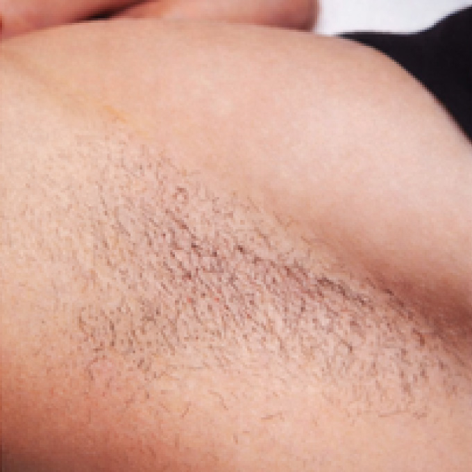 derma-2-bfr
