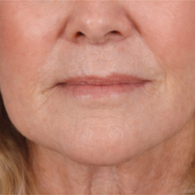 derma-3-aft