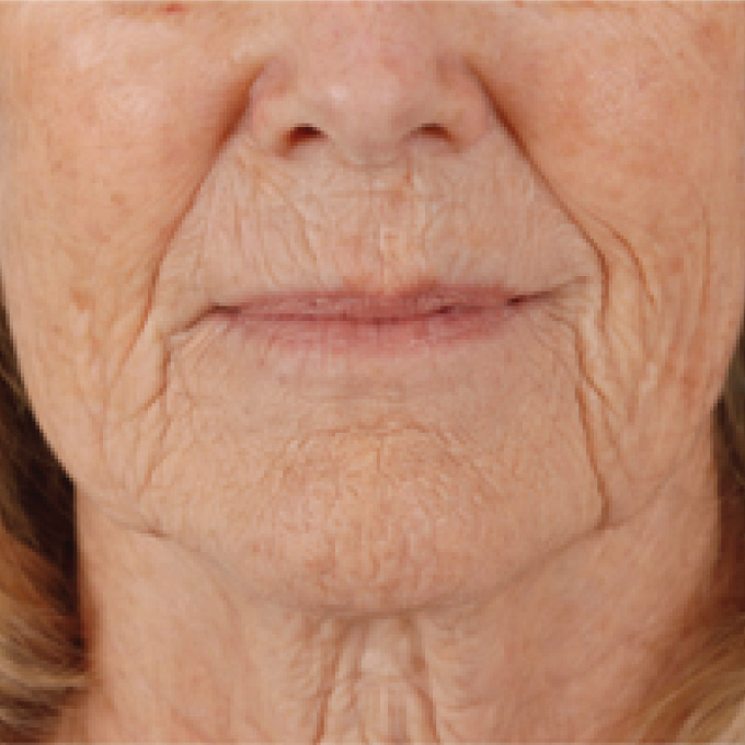 derma-3-bfr