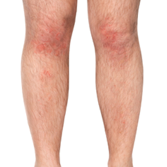 derma-4-aft