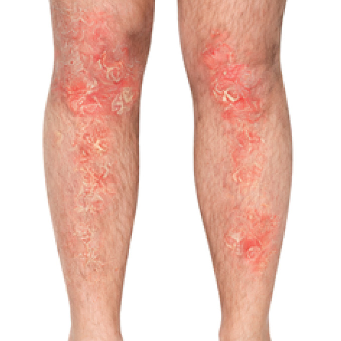 derma-4-bfr