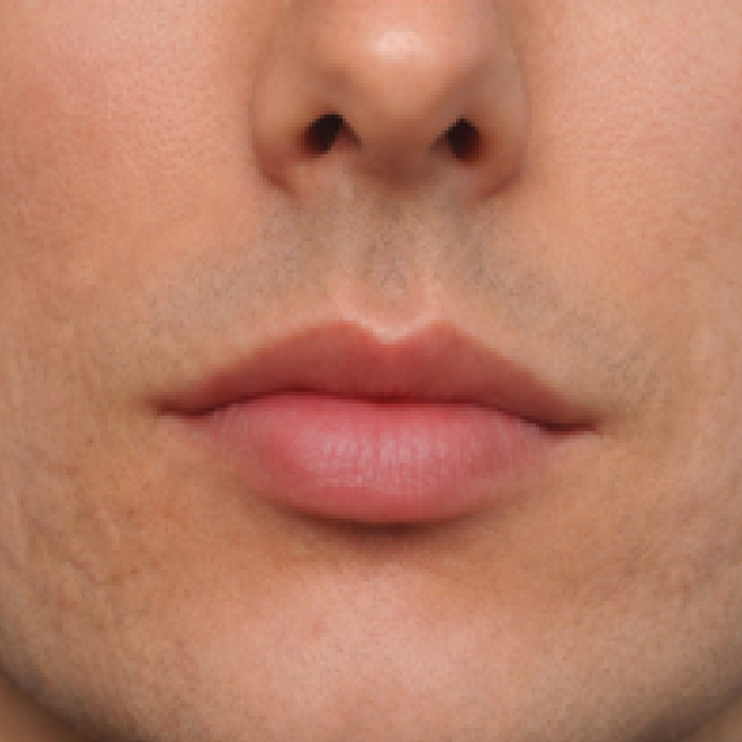 derma-5-aft