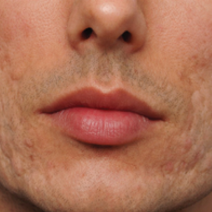 derma-5-bfr