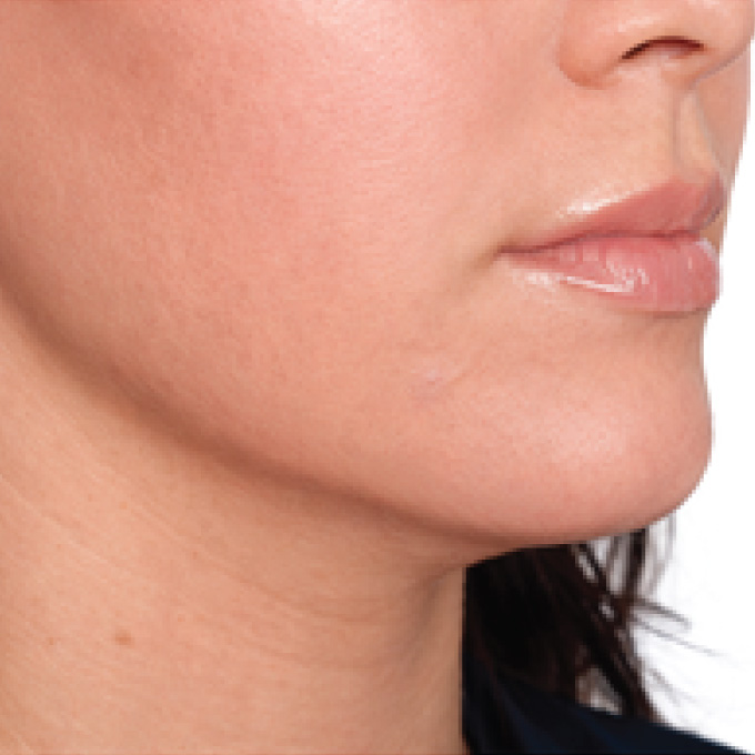 derma-6-aft