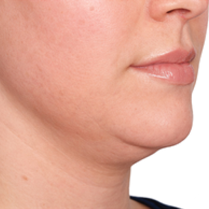 derma-6-bfr