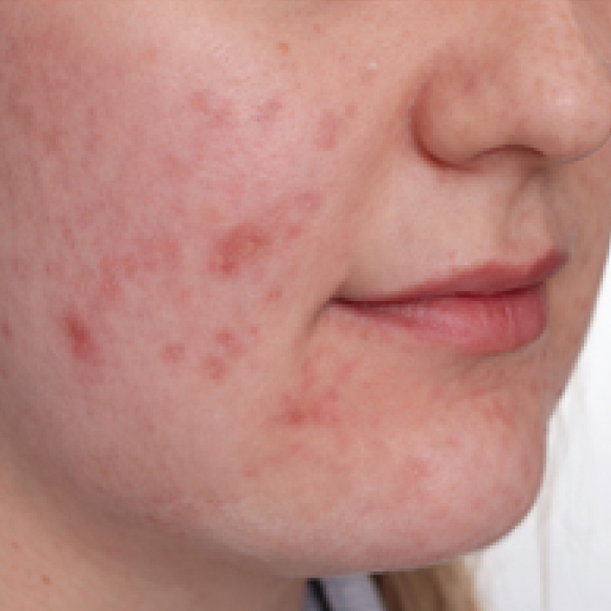 derma-7-bfr