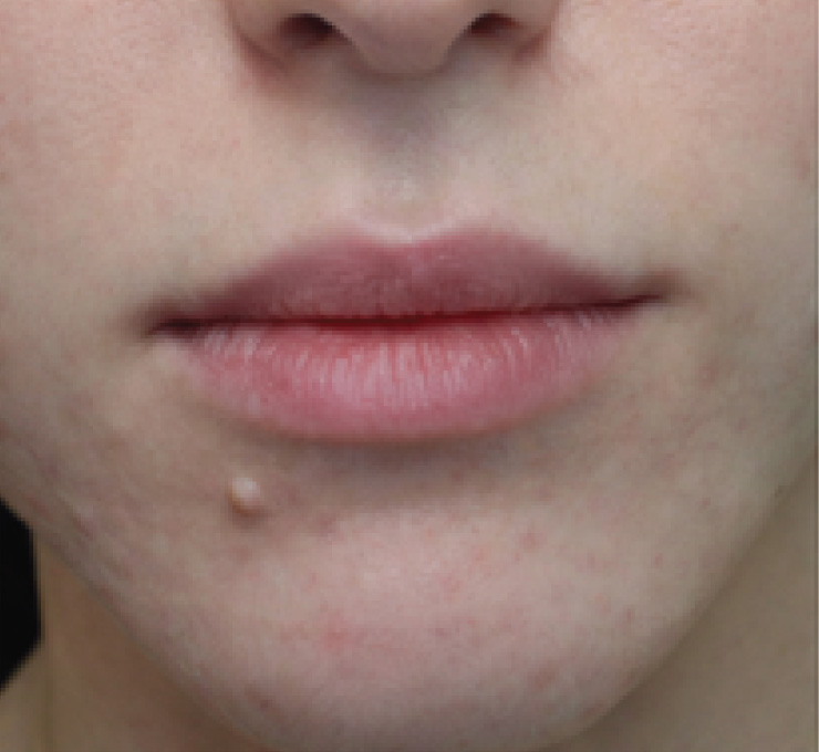 derma-8-bfr