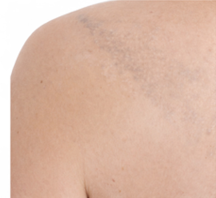 derma-9-aft