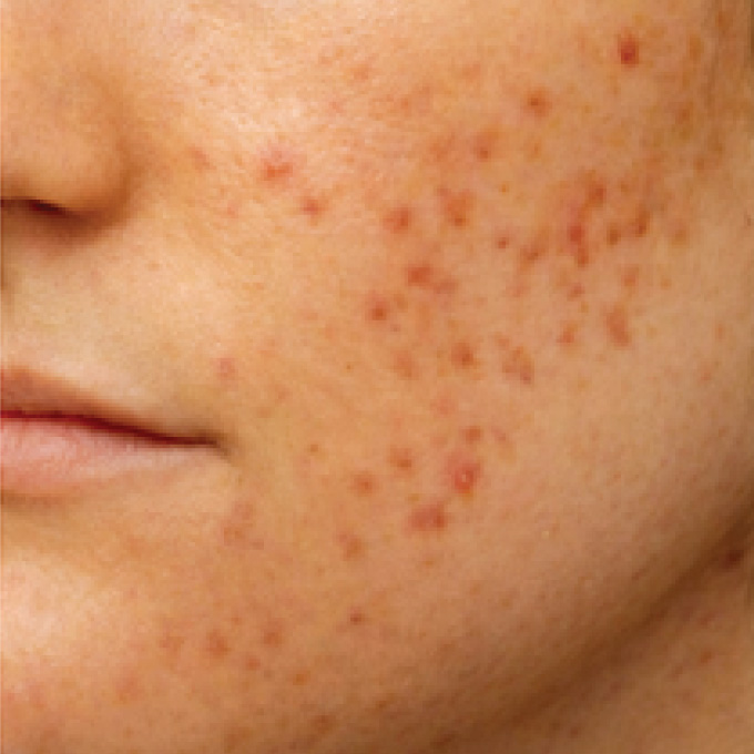 face-mark-1-bf