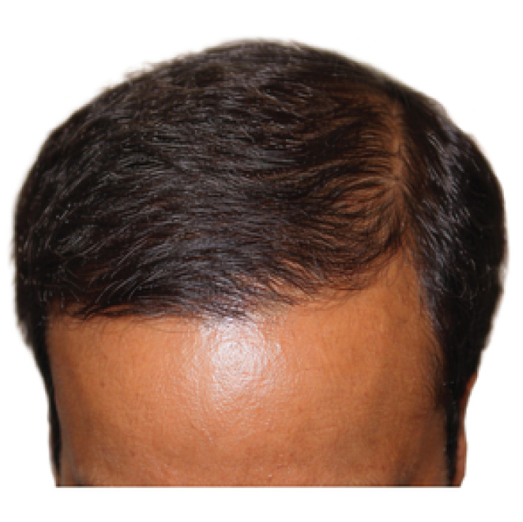 hair-treatment-2-aft