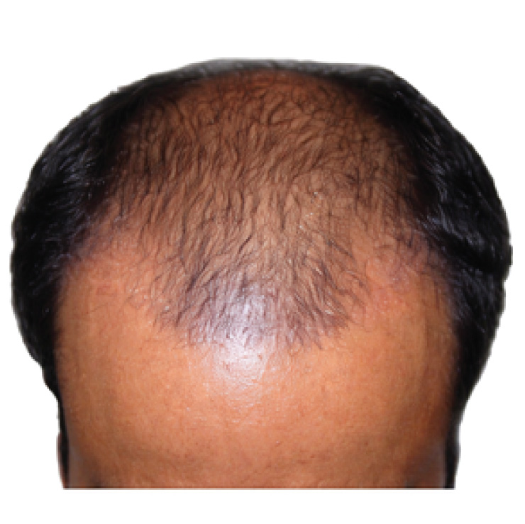hair-treatment-2-bfr