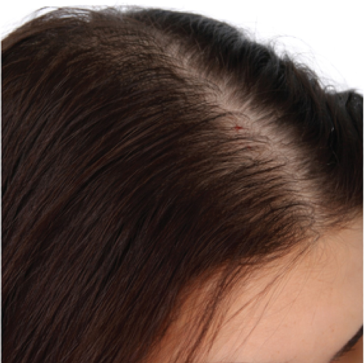 hair-treatment-3-bfr