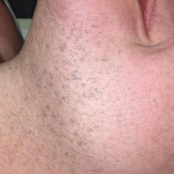 hair-treatment-5-bfr