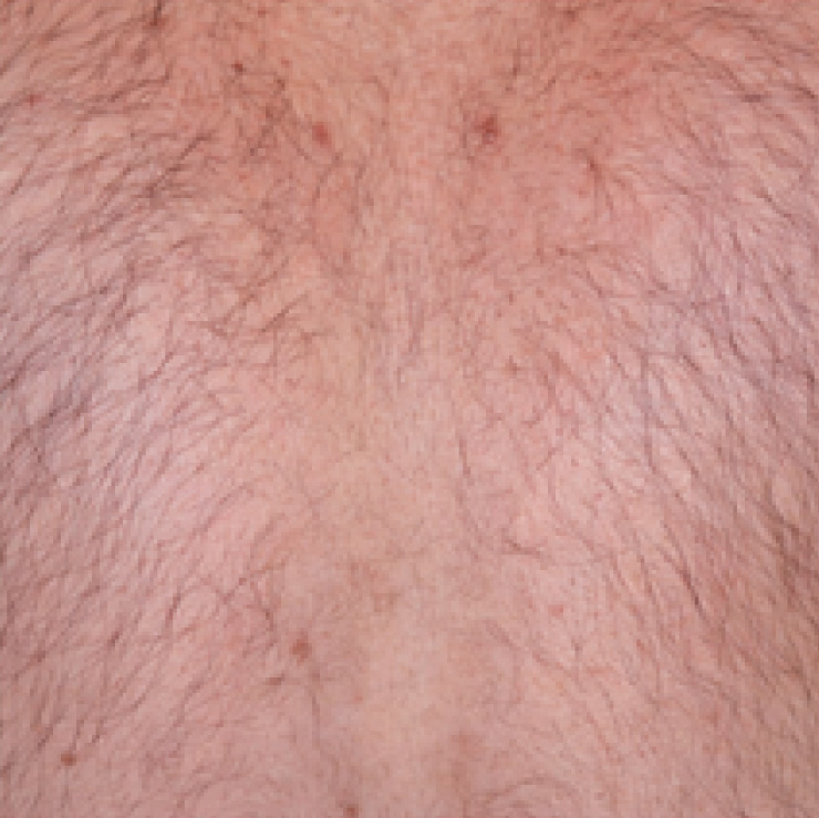 hair-treatment-7-bfr